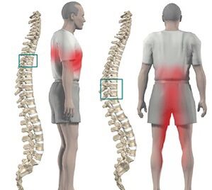 sāpes mugurkaulā ar krūšu kurvja osteohondrozi