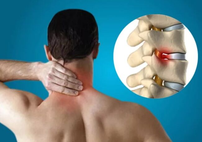 Dzemdes kakla osteohondroze