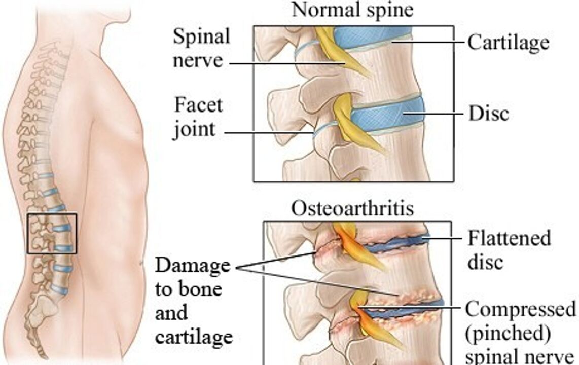 Atšķirība starp veselīgu disku un disku ar osteohondrozi