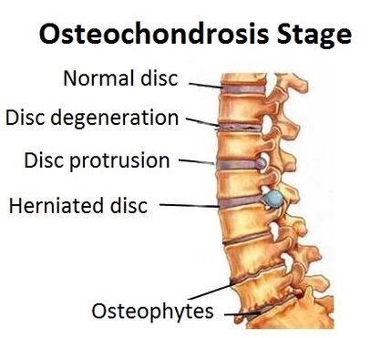Osteohondrozes posmi
